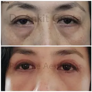 Blepharoplasty result — Lower lid blepharoplasty — before & after